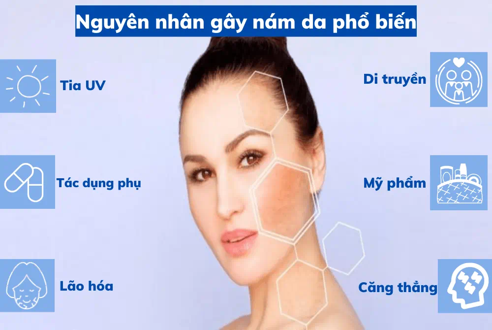 Nám da nỗi lo âu của nhiều phụ nữ Việt và phương pháp điều trị